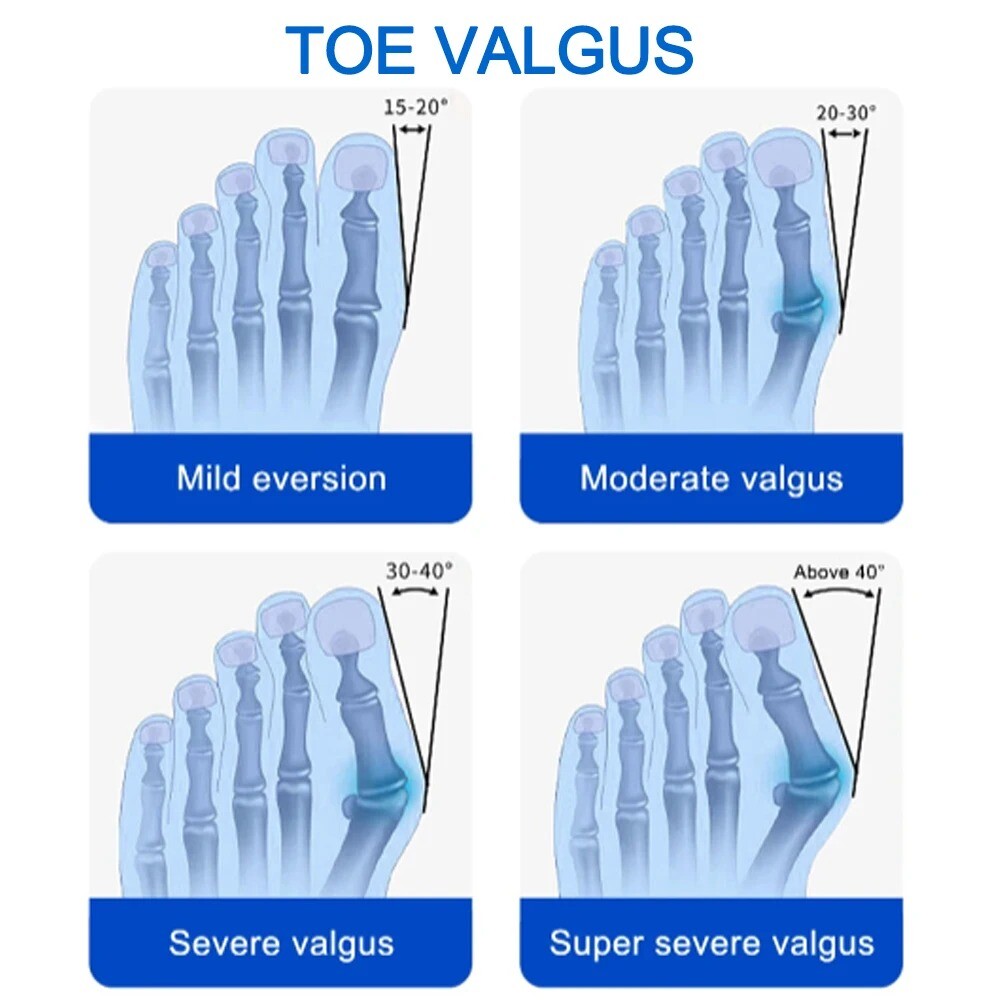 Bunion Correctors Adjustable Hallux Valgu for Big Toe Rotatable Straightener FNS