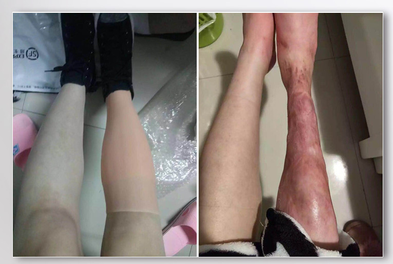 Highly Simulated Skin Silicone Prosthesis Foot Sleeve Leg Cover Scars CD
