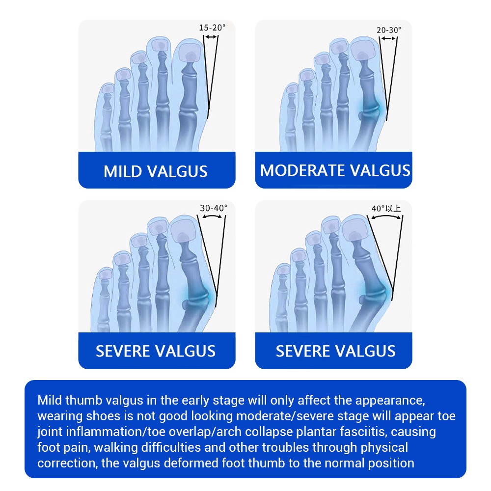 Bunion Fix Toe Valgus Corrector Big Toe Straightener Adjustable for Men & Women