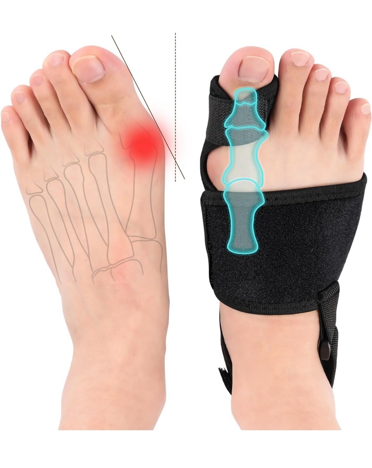 Bunion Corrector Splint for Women & Men – Orthopedic Big Toe Straightener
